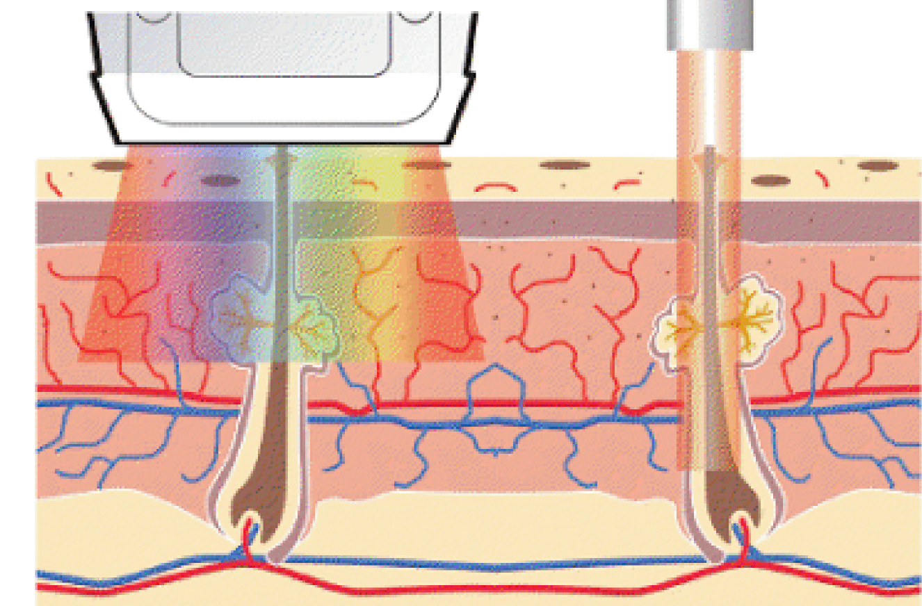 The Best Permanent Hair Removal at Home Guide Live Beauty Health