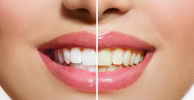 5 Most Effective Teeth Whitening Home Kits | LiveBeautyHealth